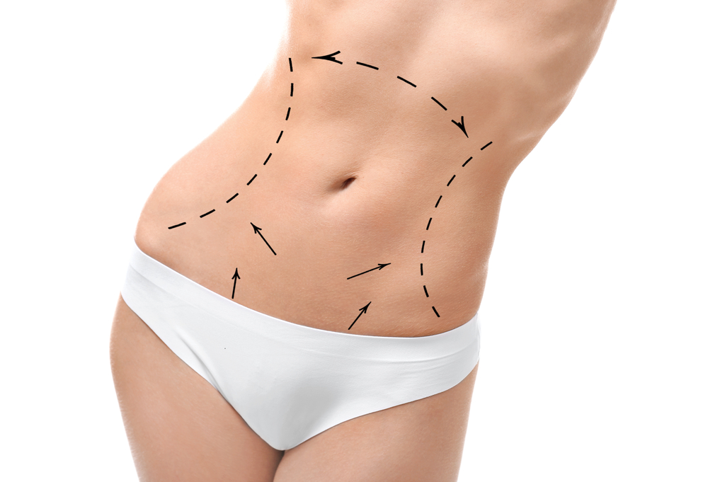 Abdomen Liposuction