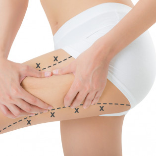 Liposuction of the Legs and Hips